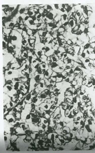 بيماريهاي تخمدان و لوله هاي رحمي چیست؟(1)